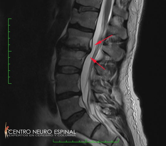 Michael Simons Spine 2